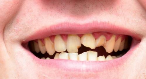 Почему зубы становятся хрупкими в 32 года: причины и решения 02