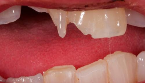 Почему зубы становятся хрупкими в 32 года: причины и решения 01