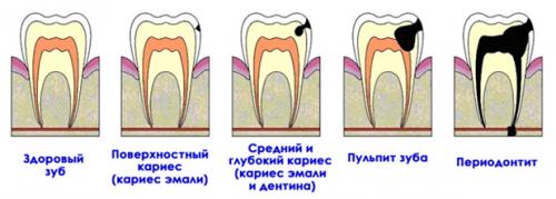 Почему у взрослых сохраняются молочные зубы: причины и последствия 02