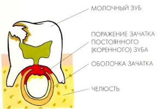 Почему у взрослых сохраняются молочные зубы: причины и последствия 01