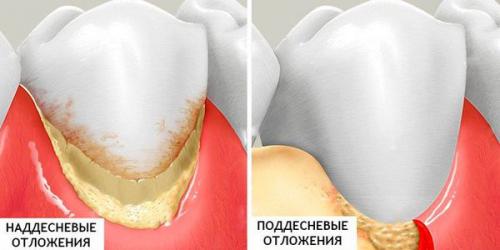 Почему зубы темнеют с возрастом: причины и решения 06