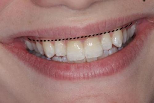 Как выглядят идеальные зубы и как часто это встречается 04