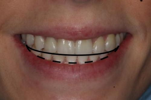 Как выглядят идеальные зубы и как часто это встречается 03