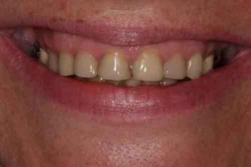 Как выглядят идеальные зубы и как часто это встречается 05