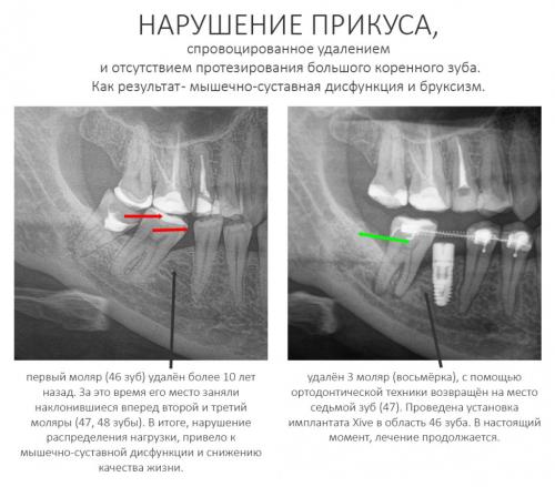 Нужно ли обращаться к ортодонту для идеального прикуса. А что же со взрослыми? Что делать тем кто уже прошёл период формирования прикуса, когда зубы уже не растут, а скорее наоборот — иногда теряются?