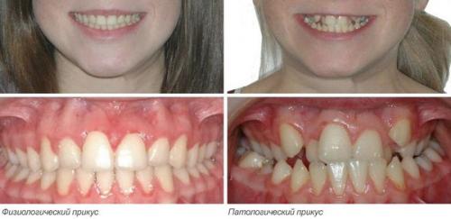 Потеря зубов: 10 фактов, которые вас удивят 03