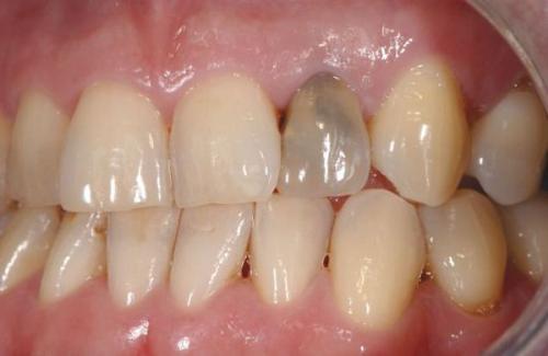 Как выглядят зубы в 40-50 лет: естественные изменения и пути их предотвращения 03