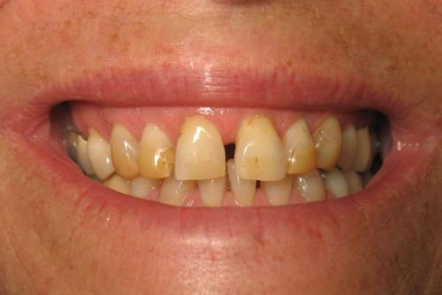 Как выглядят зубы в 40-50 лет: естественные изменения и пути их предотвращения 02