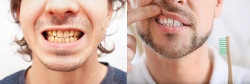 Советы по поддержанию здоровья зубов после 30 лет 04 Советы по поддержанию здоровья зубов после 30 лет 04