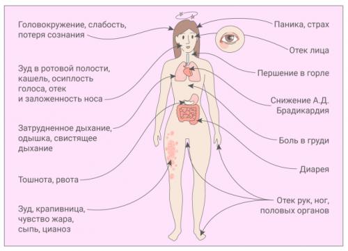 Какие симптомы могут указывать на аллергическую реакцию организма. Симптомы острой аллергической реакции