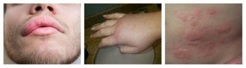 Чем можно вывести аллергены из организма 13 Чем можно вывести аллергены из организма 13