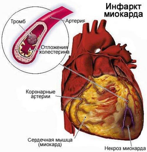 Как часто происходит связь между проблемами с зубами и сердечными заболеваниями