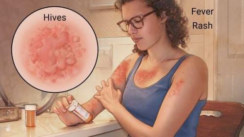 Экономический выбор: недорогие таблетки от аллергии, которые работают 01