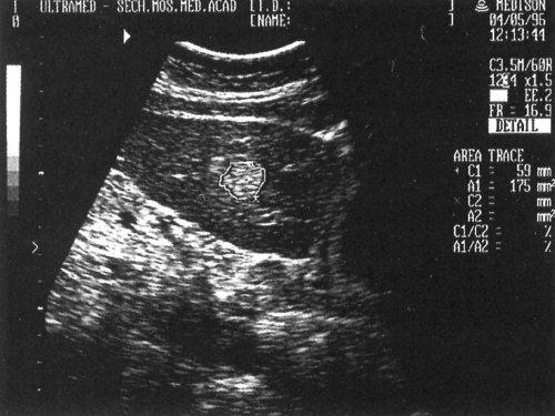 Точное расположение почек и печени в человеческом организме 05