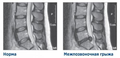 Что делать, если на рентгене обнаружились неопределенности или изменения в позвоночнике. Диагностирование грыж