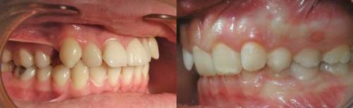 Какие органы чаще всего страдают из-за проблем с зубами. Первичные последствия потери зубов