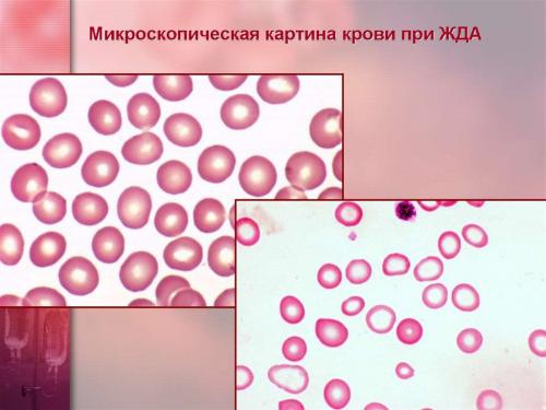Какие причины могут привести к дефициту железа в организме. Что такое ЖДА