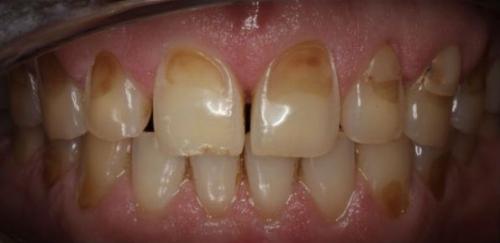 Почему неправильная чистка зубов может навредить вашему здоровью 02