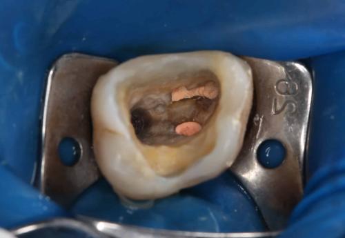 Влияет ли недостаточная Чистка зубов на развитие кариеса. Как же остановить рост кариеса?