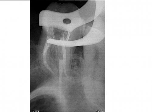 Влияет ли недостаточная Чистка зубов на развитие кариеса. Как же остановить рост кариеса?