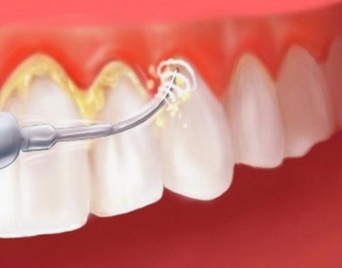 Почему чистка зубов менее чем две минуты может быть недостаточной. Оптимальное время для чистки зубов