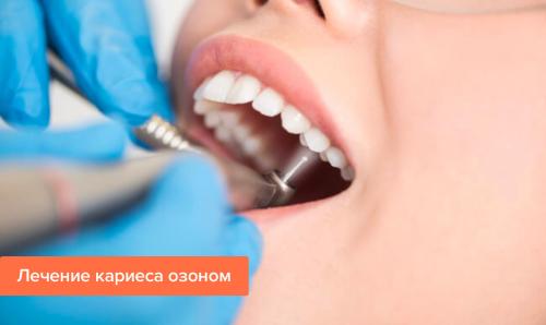 Как предотвратить кариес: советы стоматолога 02 Как предотвратить кариес: советы стоматолога 02