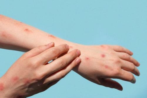 Аллергия на руках у взрослых: причины и симптомы Аллергия на руках у взрослых: причины и симптомы